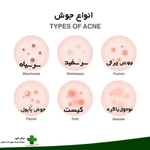 علت جوش زیر پوستی و راهکارهای درمان